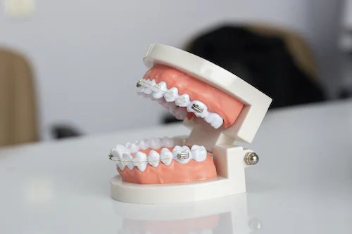 矯正器具を付けた歯の模型